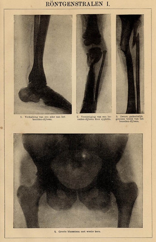 afbeelding van prent Röntgenstralen I van Winkler Prins (Geneeskunde)
