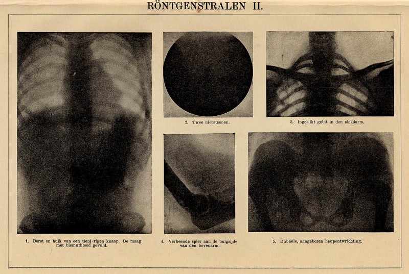 afbeelding van prent Röntgenstralen II van Winkler Prins (Geneeskunde)